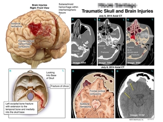 Illustration of a traumatic brain injury