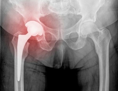 Xray of a hip replacement